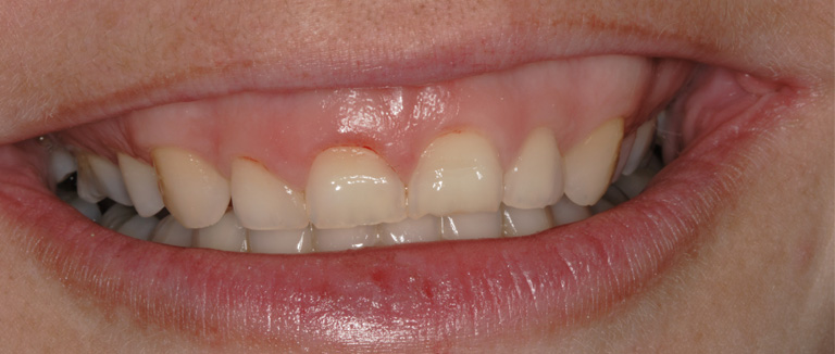 Exceso de encía: sonrisa gingival