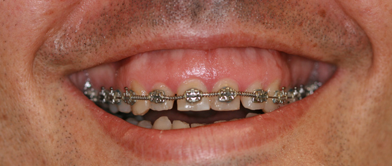 Exceso de encía: sonrisa gingival 2