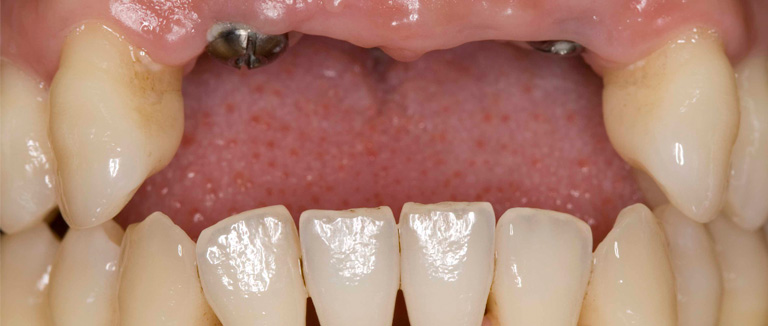 Prótesis sobre implantes. Dientes anteriores