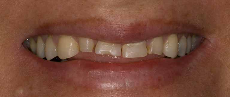 Rejuvenecimiento dental