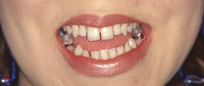 Escultura dental. Carillas de composite