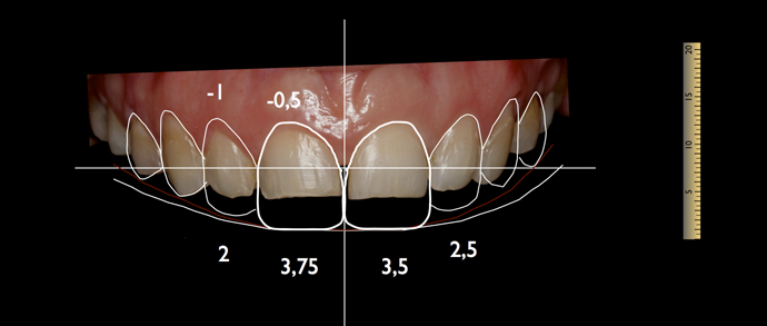 DSD. Carillas cerámicas