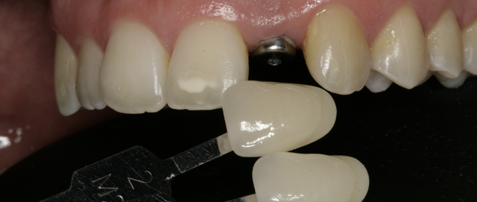 Prótesis sobre implante. Agenesia