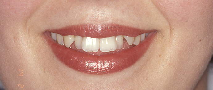 Dientes apiñados. Ortodoncia