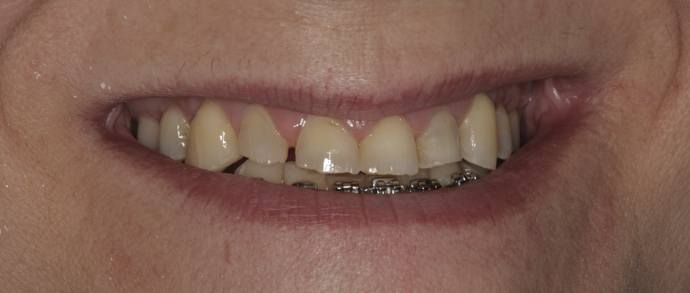 Rejuvenecimiento dental 2