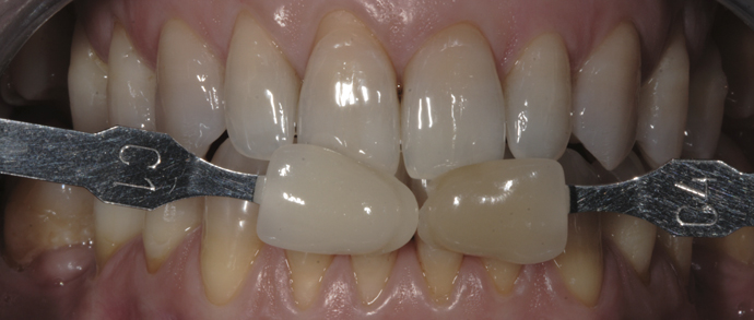 Blanqueamiento dental. Tetraciclinas