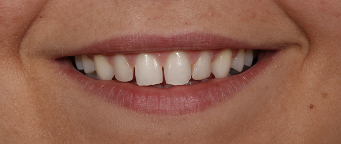 DSD. Carillas cerámicas